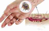 Chesoccal weal опис, симптоми на шуга, третман и превентивни дејства...