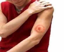 Клучни карактеристики на borreleiosis, методи на лекување...