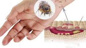 Chesoccal weal опис, симптоми на шуга, третман и превентивни дејства